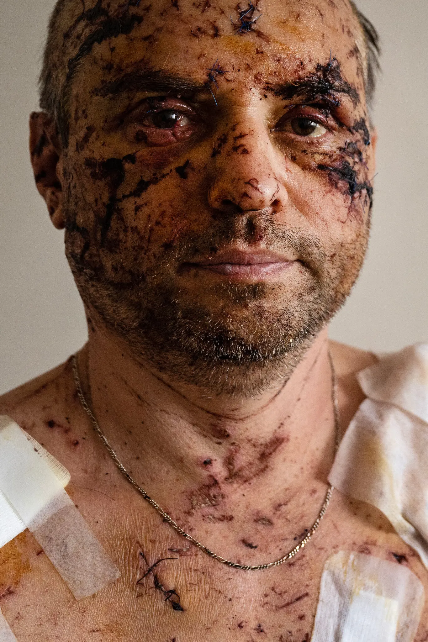 50-річний Олег Валовий одужує в лікарні після серйозних поранень під час російського ракетного обстрілу його житлового будинку в центральному українському місті Дніпро 14 січня